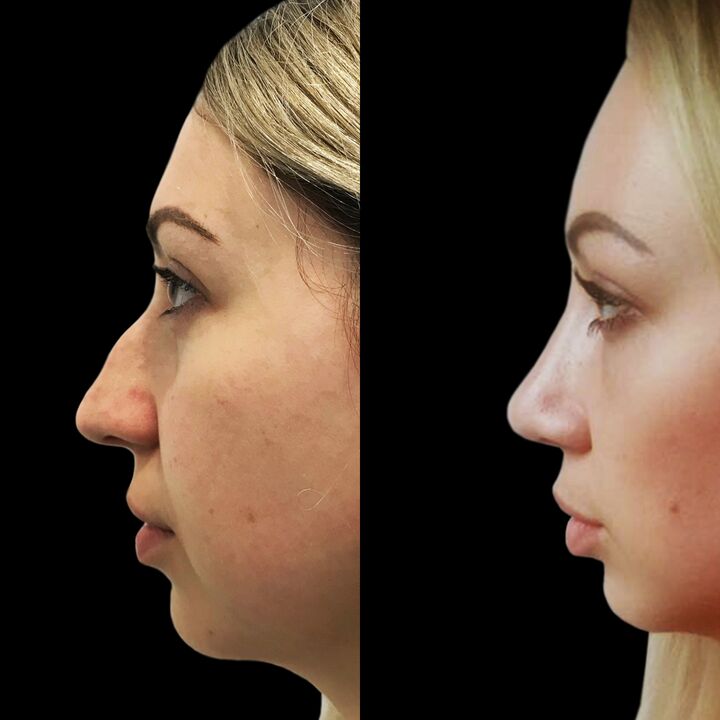 Rinoplasty