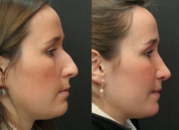 Rinoplastia gabeko ez den eta ondoren