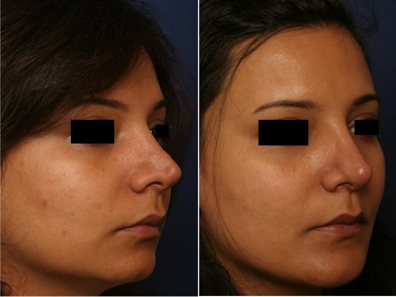 kirurgia plastikoaren emaitza