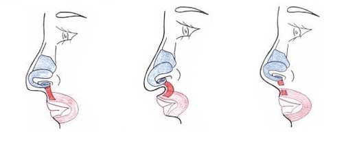 Sudurreko muskuluaren zati baten mozketa