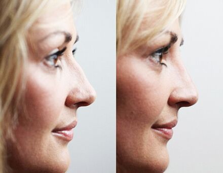 Betegarriekin rinoplastia aurretik eta ondoren