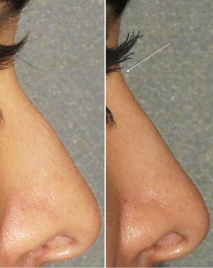 Errunoplastia ez-kirurgikoa baino lehen eta ondoren