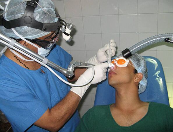 septumaren zuzenketa laser bisturia erabiliz