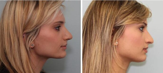 Errinoplastiaren emaitzak aurretik eta ondoren
