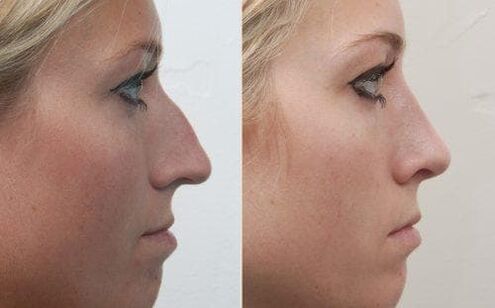 Errunoplastia ez-kirurgikoa baino lehen eta ondoren